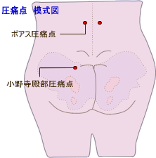 小野寺圧痛点・ボアス圧痛点 模式図