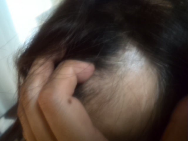 円形脱毛症 前頭部患部の状態