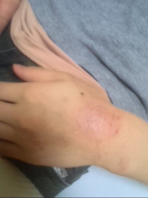 アトピー性皮膚炎 患部の状態 02