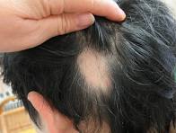 円形脱毛症のイメージ